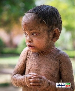 یک دختر ۲ ساله با پوست سوسماری
