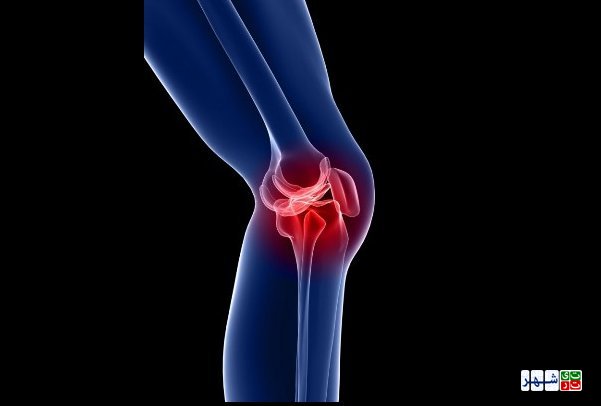 دررفتگی مفصل کشکک زانو در زنان شایع‌تر از مردان است