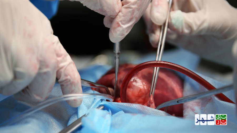 عجیب ترین جراحی‌های پیوند عضو در جهان