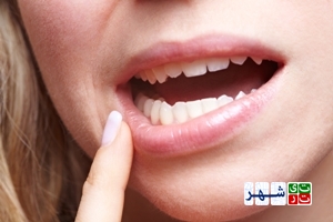 ۷ توصیه مفید برای درمان زخم دهان