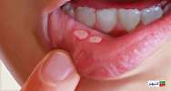 درمان سریع آفت دهان با روش‌های خانگی