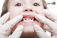 پوسیدگی دندان رایج‌ترین مشکل مردم جهان