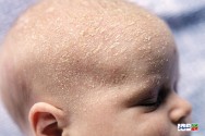 علت و درمان پوست پوست شدن سر نوزاد