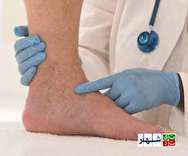 لخته شدن خون در پا نشانه بیماری است ؟ + علت